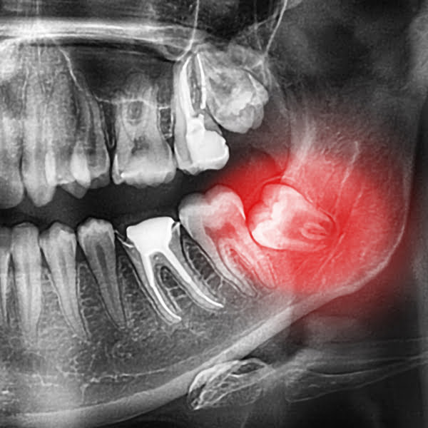 radiografía de dientes y encías