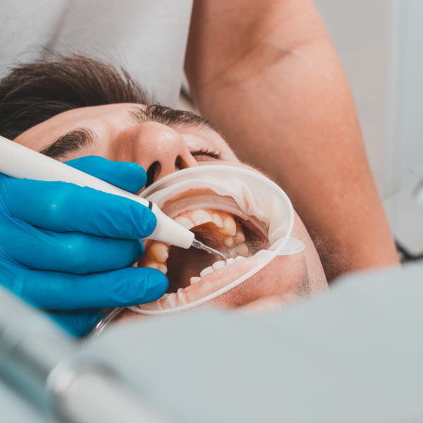 Un hombre recibe una limpieza dental por parte de un dentista.